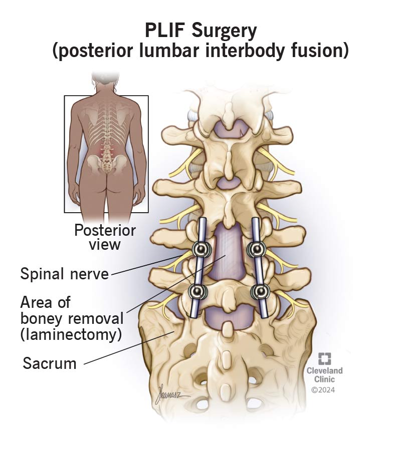 Posterior lumbar interbody fusion (PLIF) treats lower back pain (left inset) by replacing damaged disks with bone grafts.