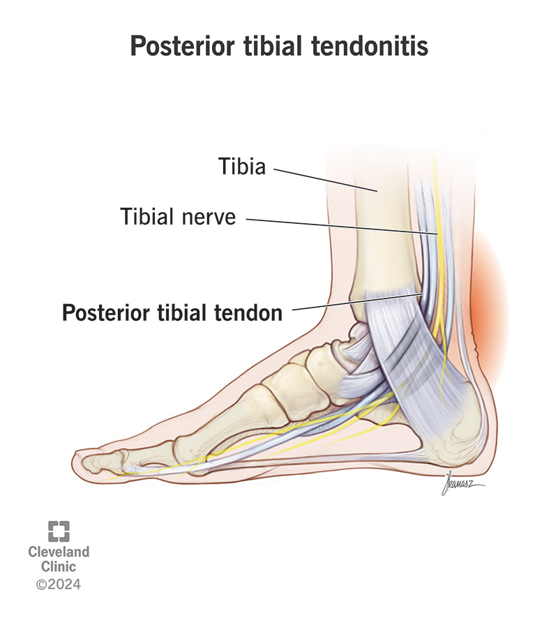 Posterior tibial tendonitis causes pain in the tendon that supports the arch of your foot.