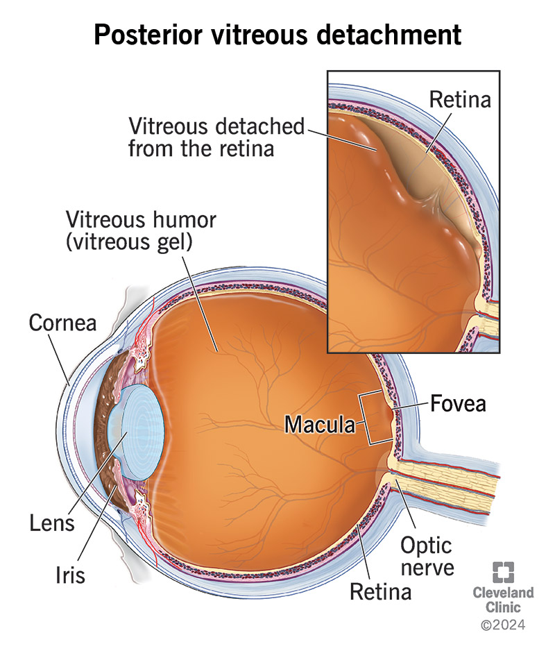 In posterior vitreous detachment, the vitreous gel separates from your retina