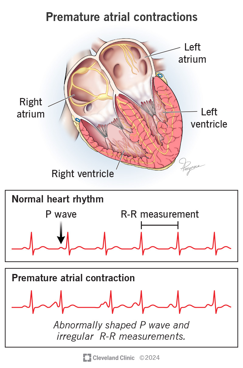 Premature atrial contractions (extra heartbeats) may show up as abnormal results on an EKG.