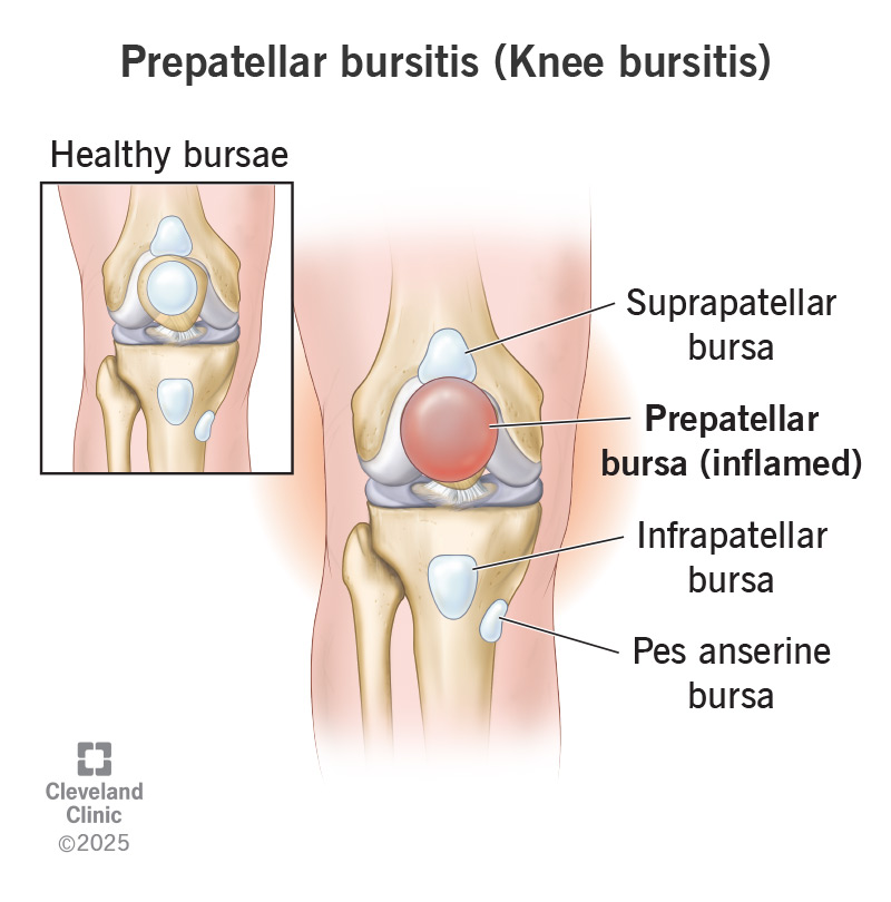 Prepatellar Bursitis Knee Bursitis Symptoms Treatment