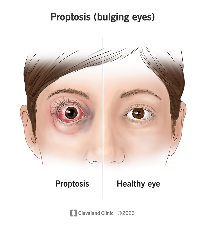 Comparing proptosis to a healthy eye.