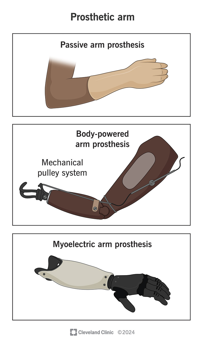 Illustration showing different types of prosthetic arms.