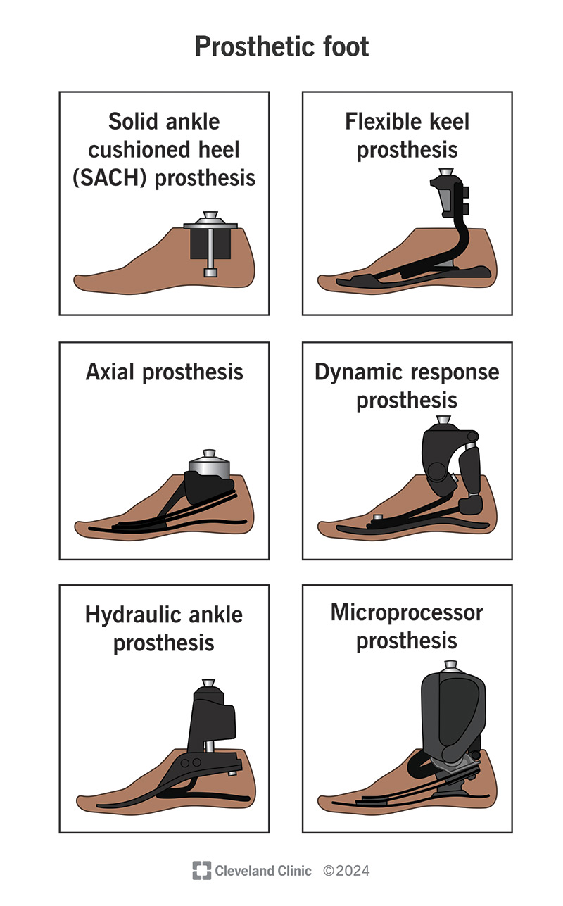 Prosthetic Foot: What It Is, Who Needs It &amp; How It&rsquo;s Used