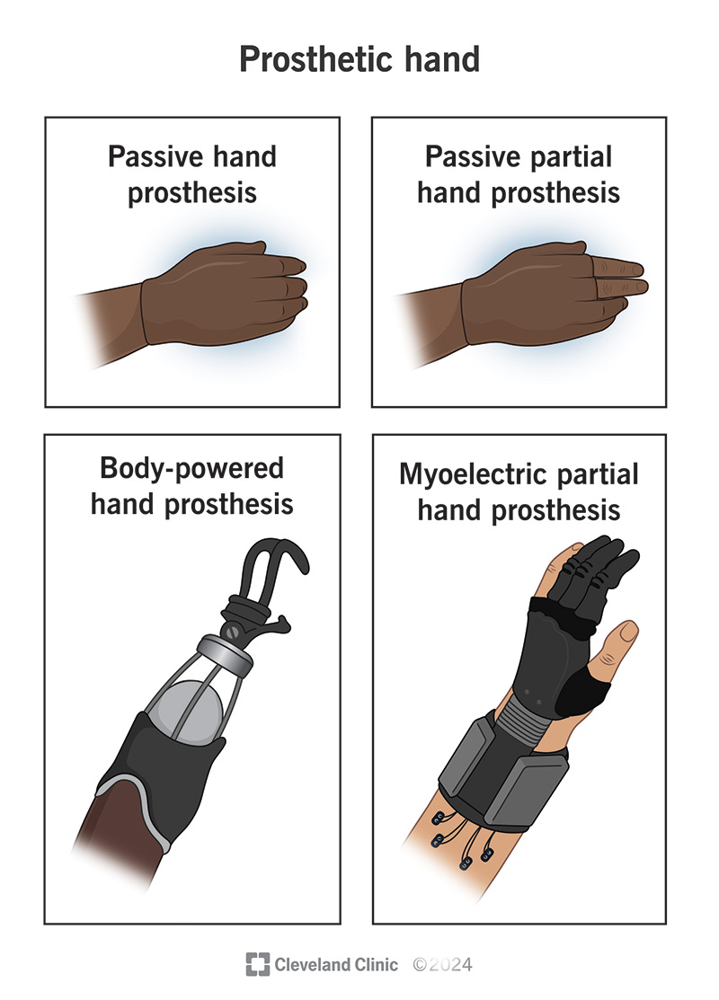 Illustration of different types of prosthetic hands.