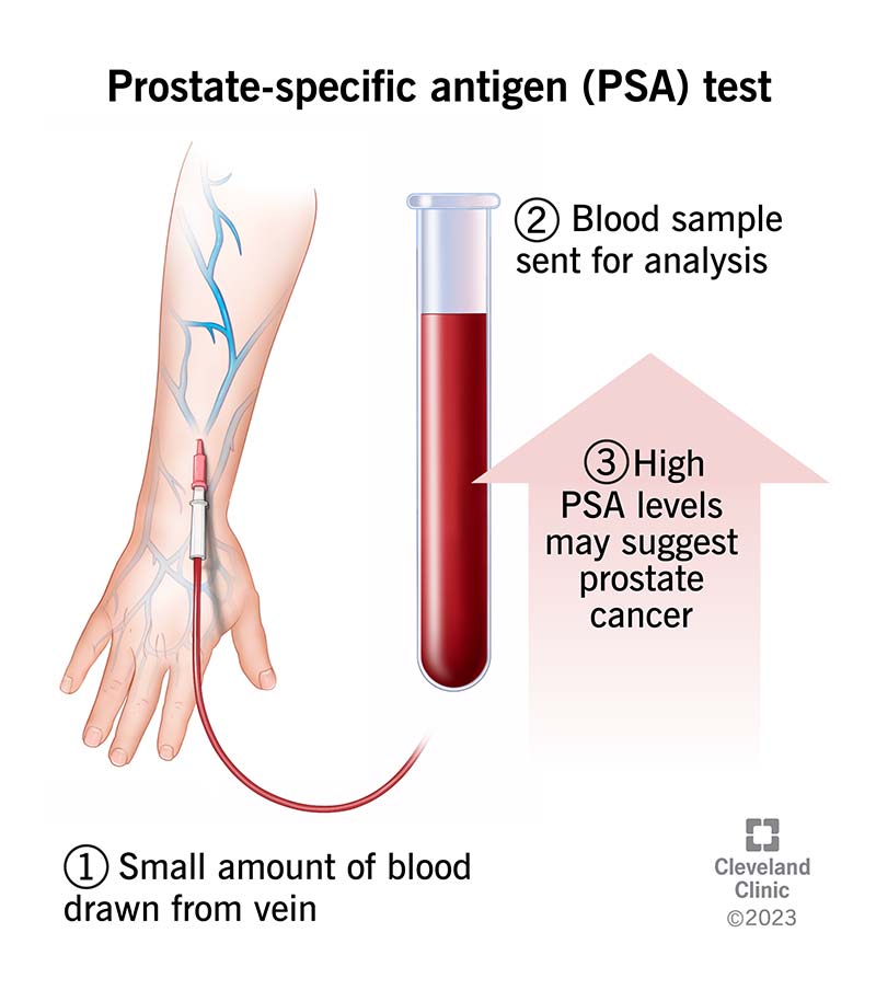 During a PSA test, a provider draws blood from your arm and tests the sample for elevated prostate-specific antigen levels.