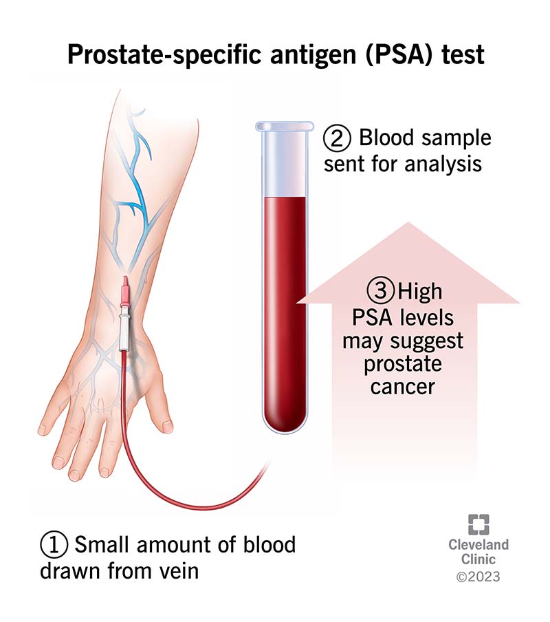 Prostate Specific Antigen PSA Test Purpose Results