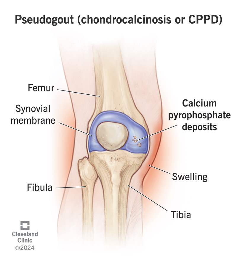 Pseudogout causes calcium pyrophosphate crystals to build up in your joints.