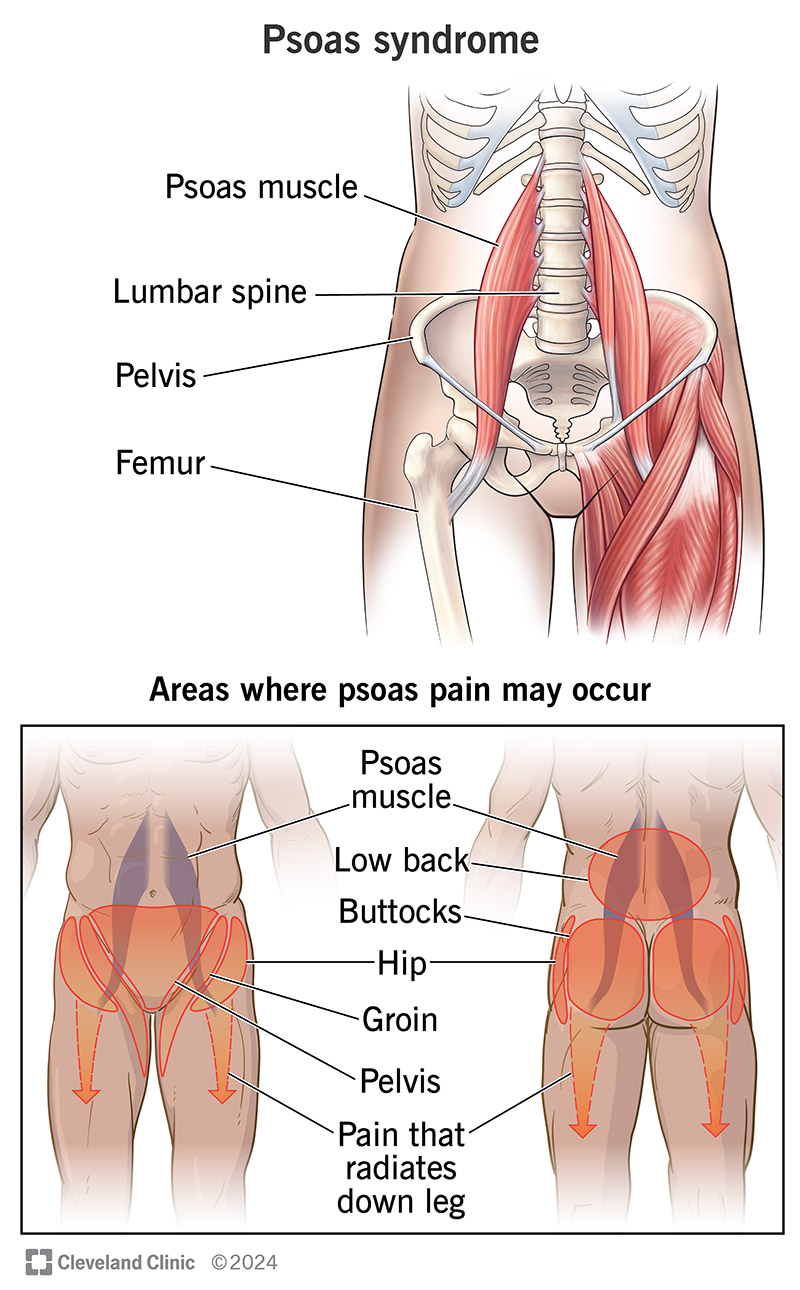 Psoas syndrome can cause pain in your back, groin, hips and butt.