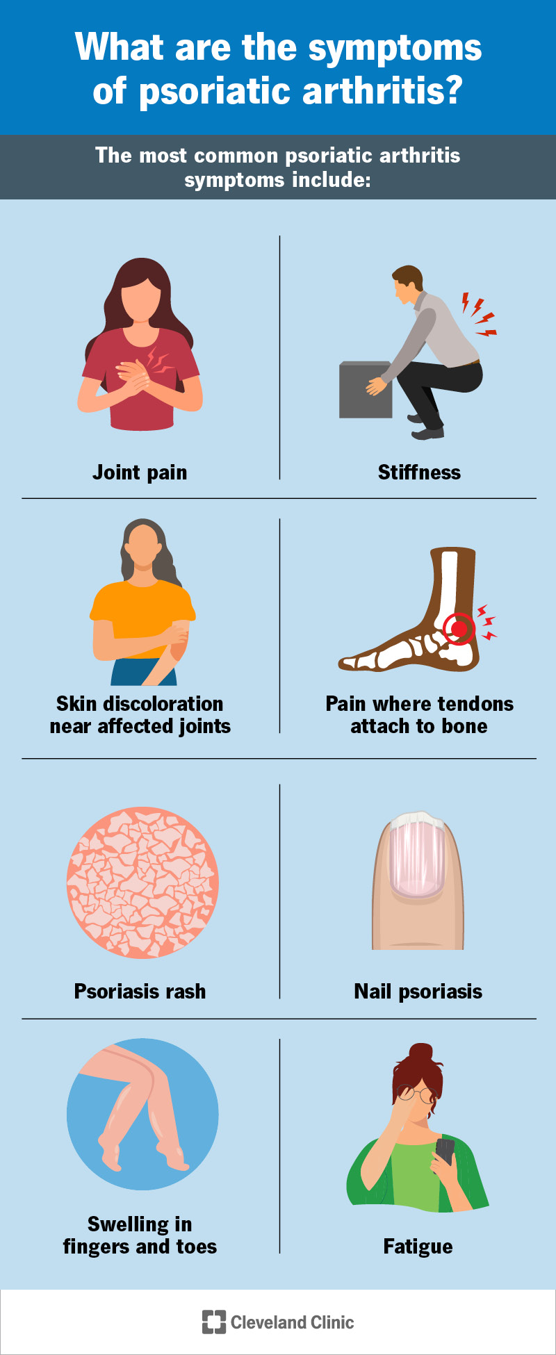 Examples of psoriatic arthritis symptoms, including skin, nail and joint issues