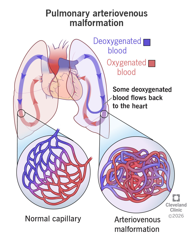 Heart and lung anatomy, comparing normal blood flow through capillaries with blood flow through an arteriovenous malformation