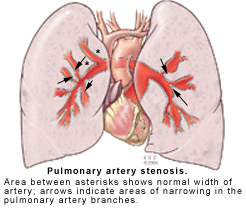 sténose de l'artère pulmonaire