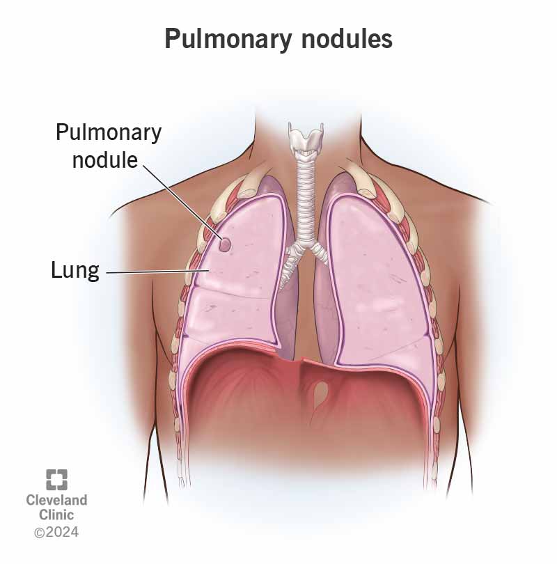 The inside of a person’s lungs with a pulmonary nodule in the right upper lobe