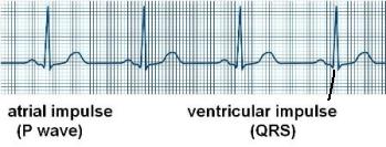 Pulmonary Vein Isolation Ablation | Cleveland Clinic