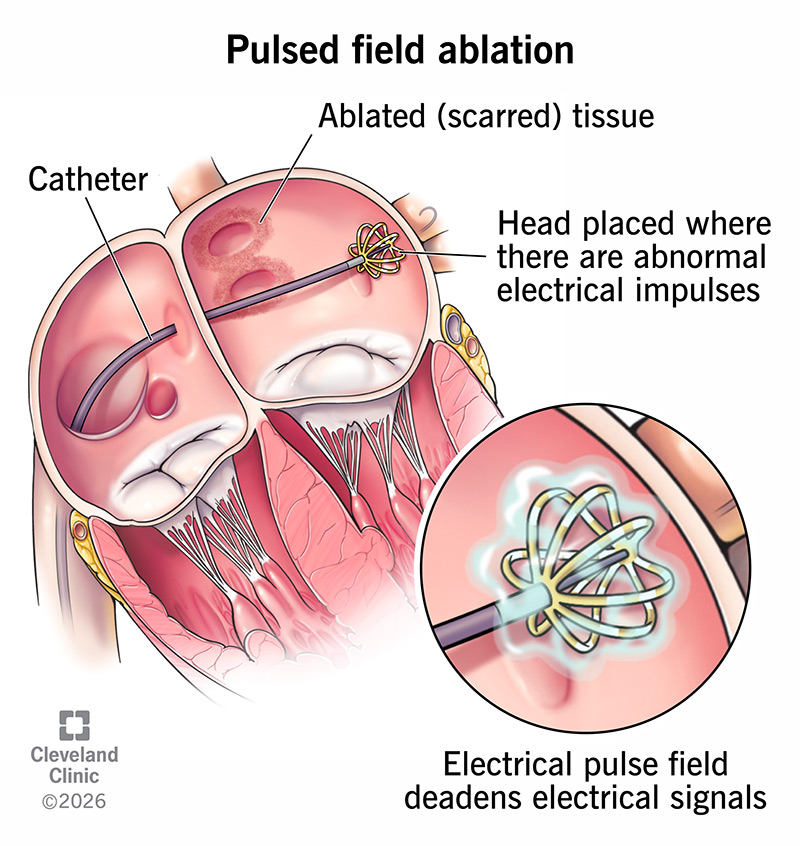 Using electrical pulses instead of heat or cold, pulsed field ablation treats atrial fibrillation