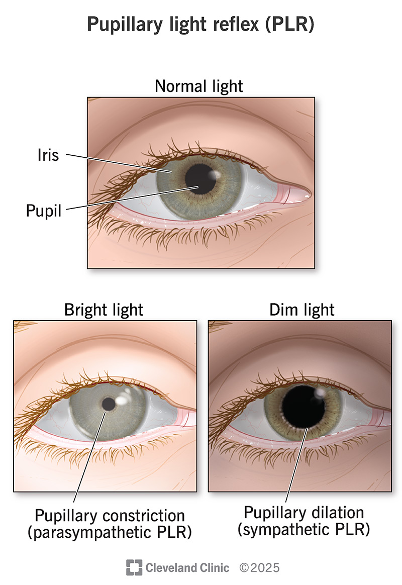 Your pupillary light reflex makes your pupils in your irises (top) shrink in bright light or become bigger in dim light