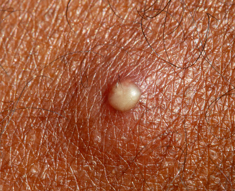 A pustule beneath the skin’s surface that contains pus, a milky fluid that forms because of an immune response