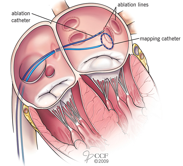 Energy goes through the tip of the catheter to tissue that's targeted for ablation.