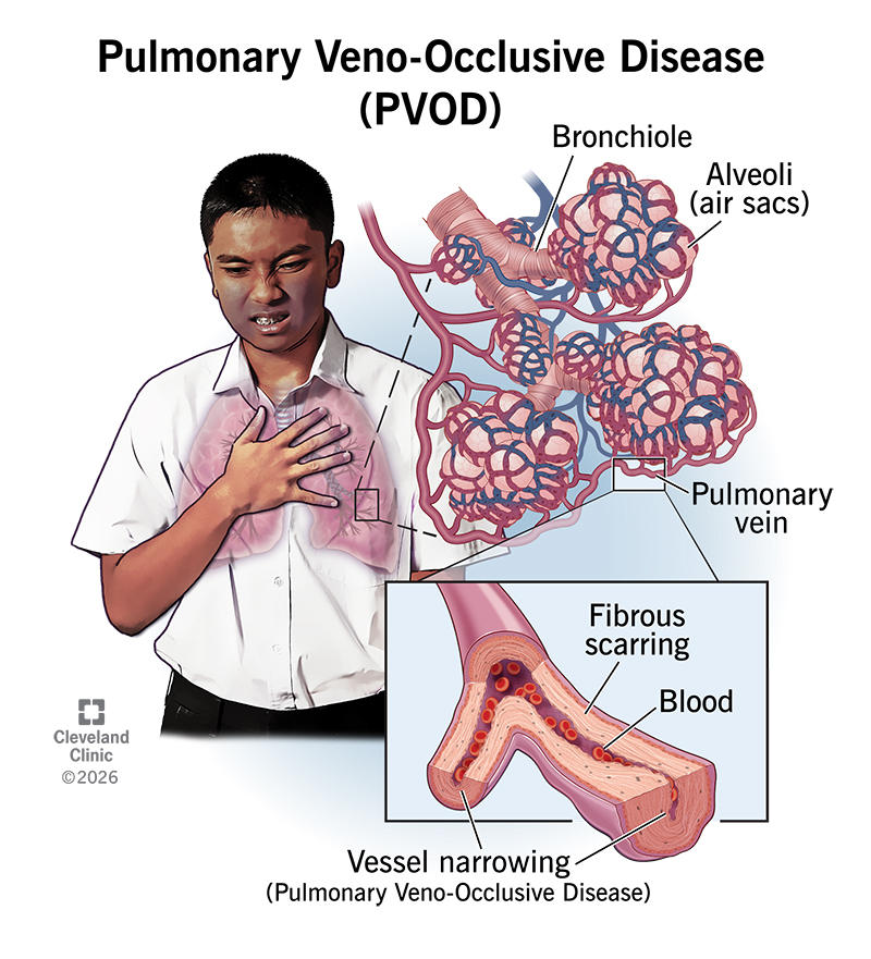 Person grasping their chest, with anatomy of PVOD, with vessel narrowing in pulmonary vein
