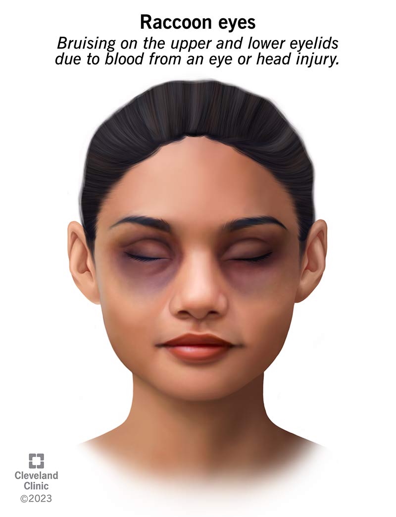 Raccoon eyes are bruises on a person’s upper and lower eyelids.