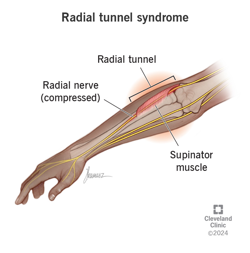 A compressed radial nerve in the radial tunnel.