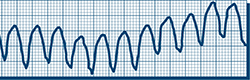 Taquicardia ventricular