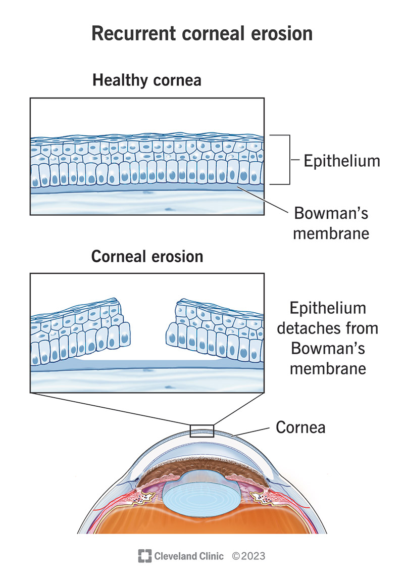 Recurrent corneal erosion causes repeated gaps in the epithelium because of weak bonding between it and Bowman’s membrane.