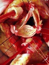 Photographies d'une opération où la valve aortique et les artères coronaires doivent être réimplantées dans un nouveau tube de remplacement de la racine aortique.