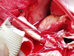 Nähte werden durch den Ring der Aortenklappe und den unteren Abschnitt des Dacron-Transplantats genäht.