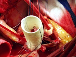Le greffon est abaissé en place, autour de l'extérieur de la valve aortique.