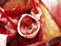 Wenn Sie in das Transplantat blicken (Draufsicht), können Sie die Aortenklappe sehen.  Die Aortenklappe wird in der neuen Röhre befestigt und die Koronararterien werden wieder befestigt.  Das Ende des Transplantats wird dann an die Aorta genäht