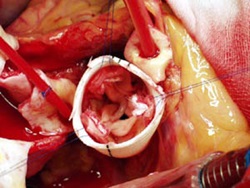 Jika Anda mengintip ke dalam cangkok (tampilan atas), Anda dapat melihat katup aorta.  Katup aorta diamankan di dalam tabung baru dan arteri koroner disambungkan kembali.  Ujung cangkok kemudian dijahit ke aorta