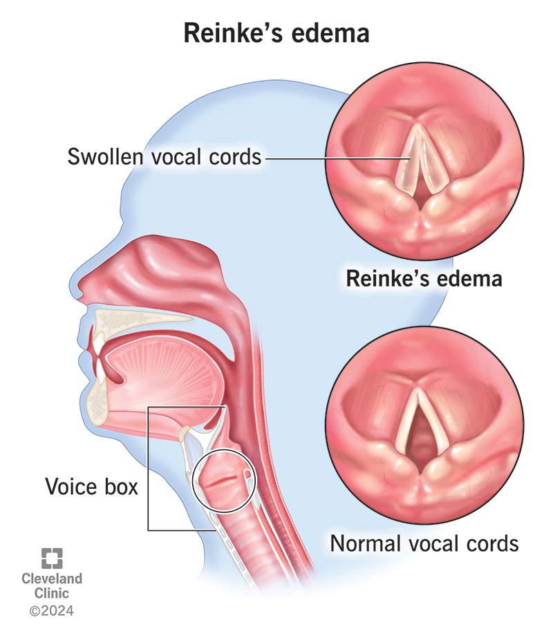 Reinke’s edema (swollen vocal cords) vs. normal vocal cords