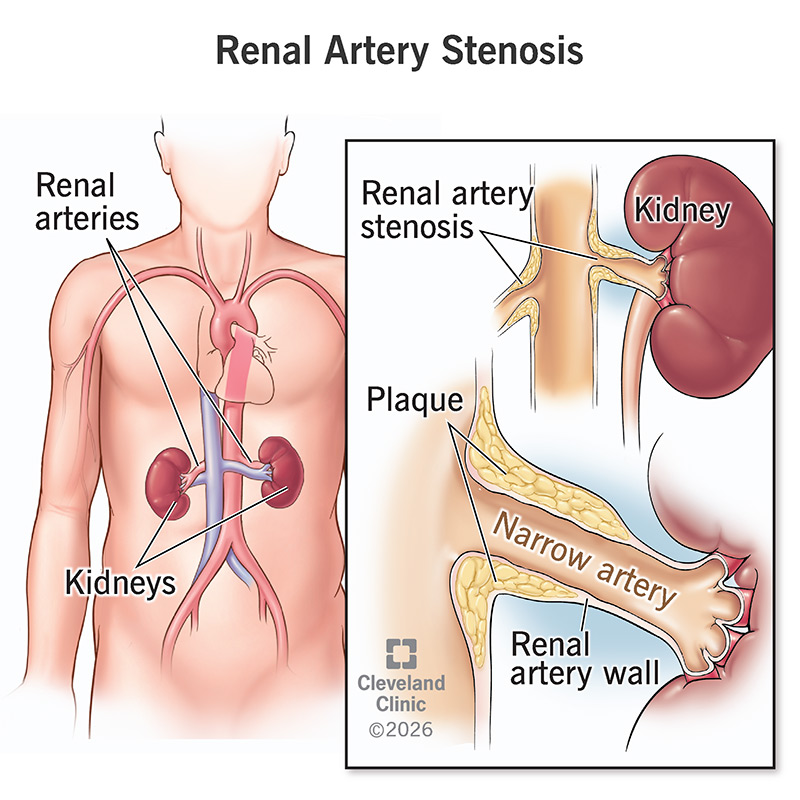 Anatomy of renal arteries and kidneys, with renal artery stenosis and plaque buildup in renal artery wall