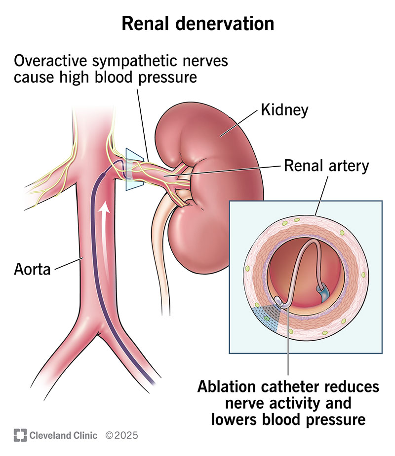 A renal denervation procedure uses a catheter to damage nerves near the kidney that help raise blood pressure