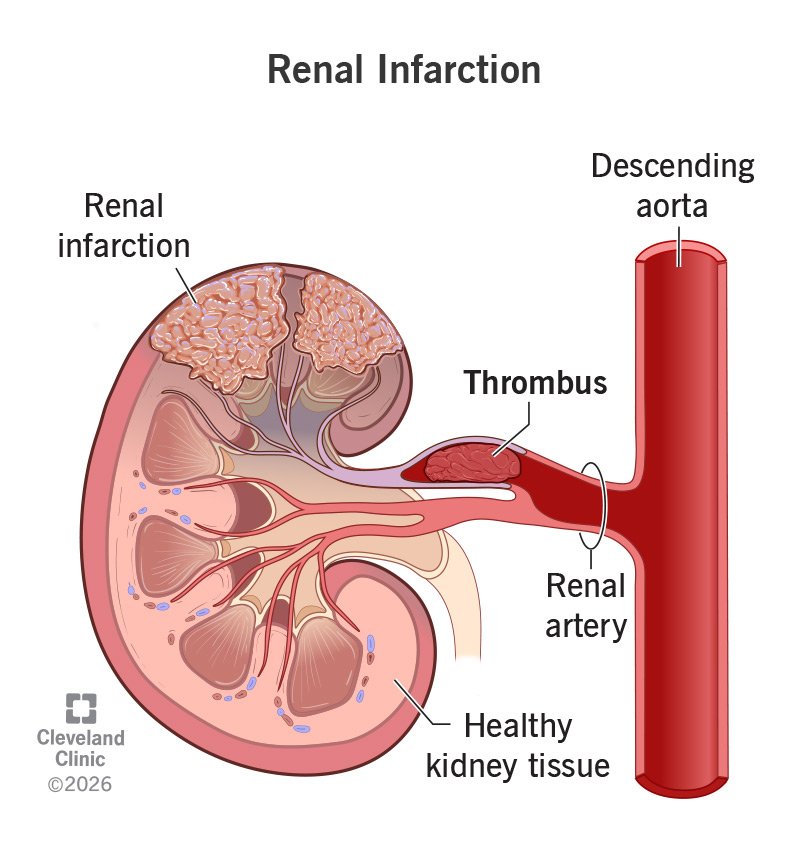 Kidney with renal infarction, a lack of blood flow to kidney tissue