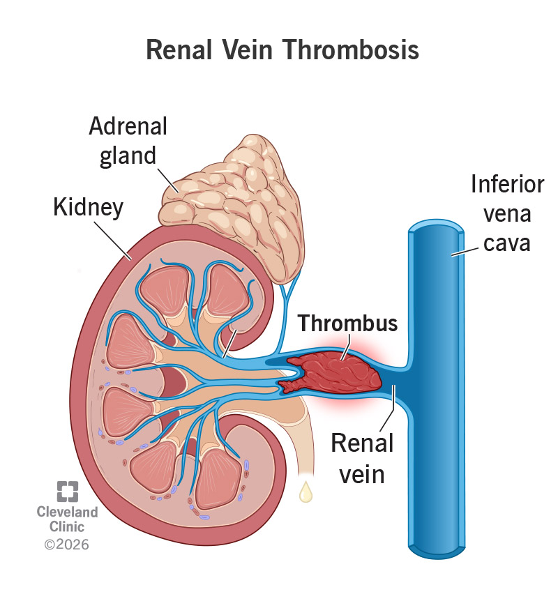 Anatomy of blood clot (thrombus) in a vein of a kidney, known as renal vein thrombosis