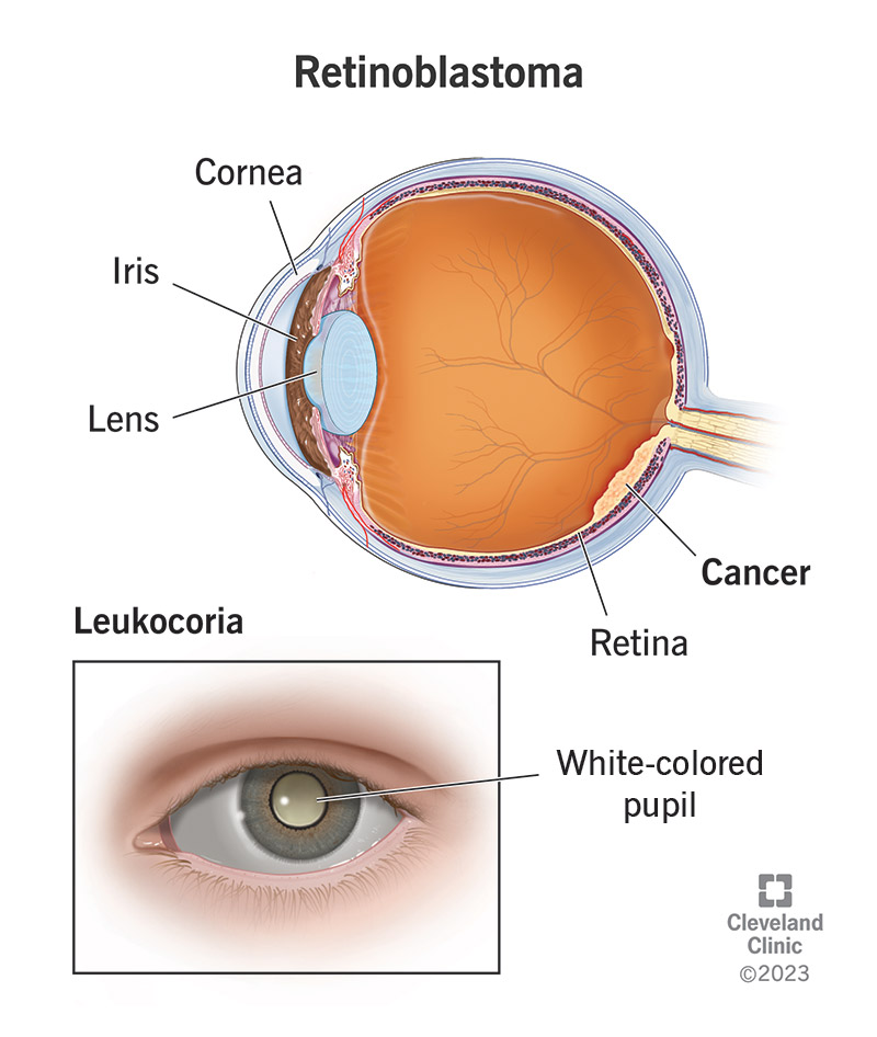 Anatomy of eye with retinoblastoma, including cancer in retina and a white pupil