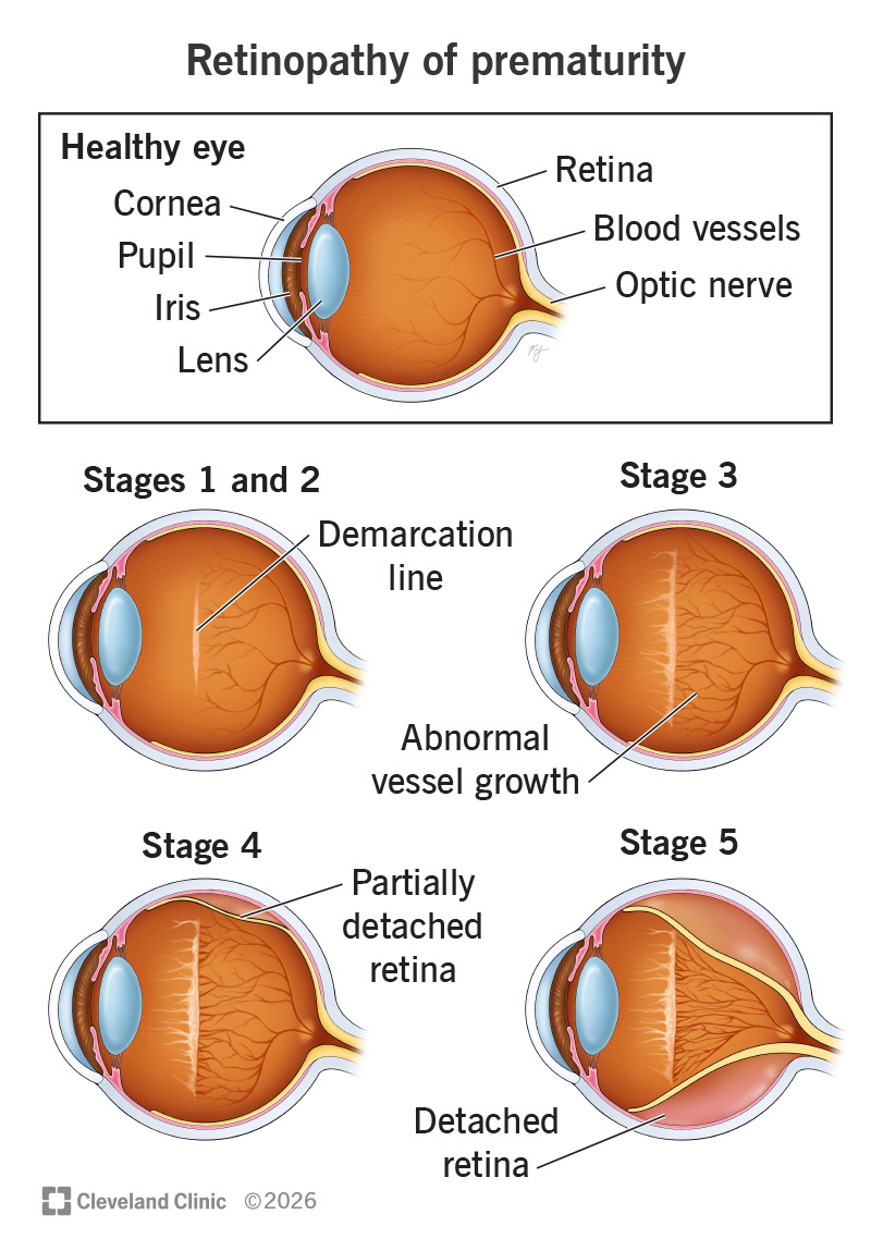 Retinopathy of prematurity happens in some babies who are born early