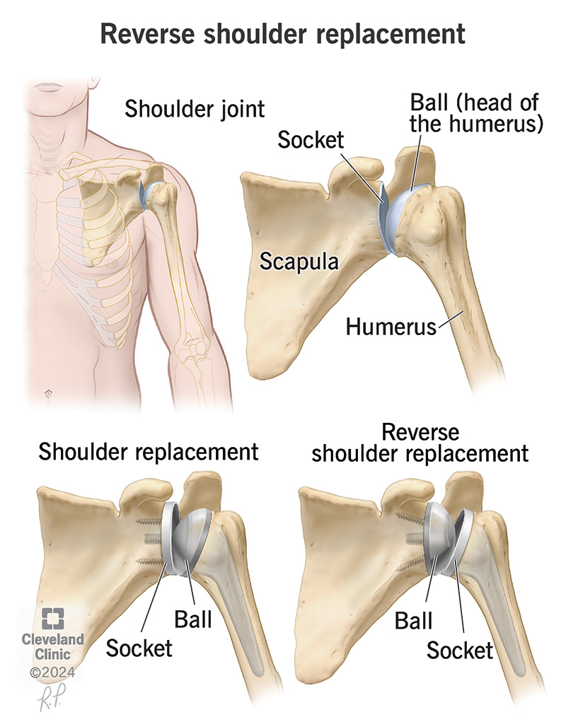 Reverse shoulder replacement gets its name from how the prosthetic joint fits into your shoulder