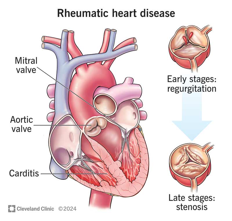 Rheumatic heart disease affects your heart’s mitral or aortic valves, making them narrow or leaky.