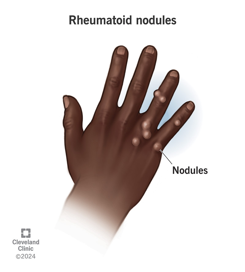 Rheumatoid nodules are benign (noncancerous) tumors that form under your skin when you have rheumatoid arthritis (RA)