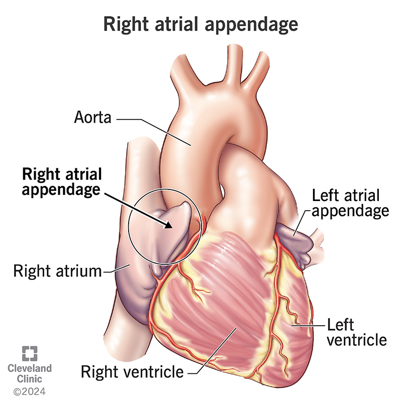 Your right atrial appendage extends from the upper part of your heart’s upper right chamber (atrium).