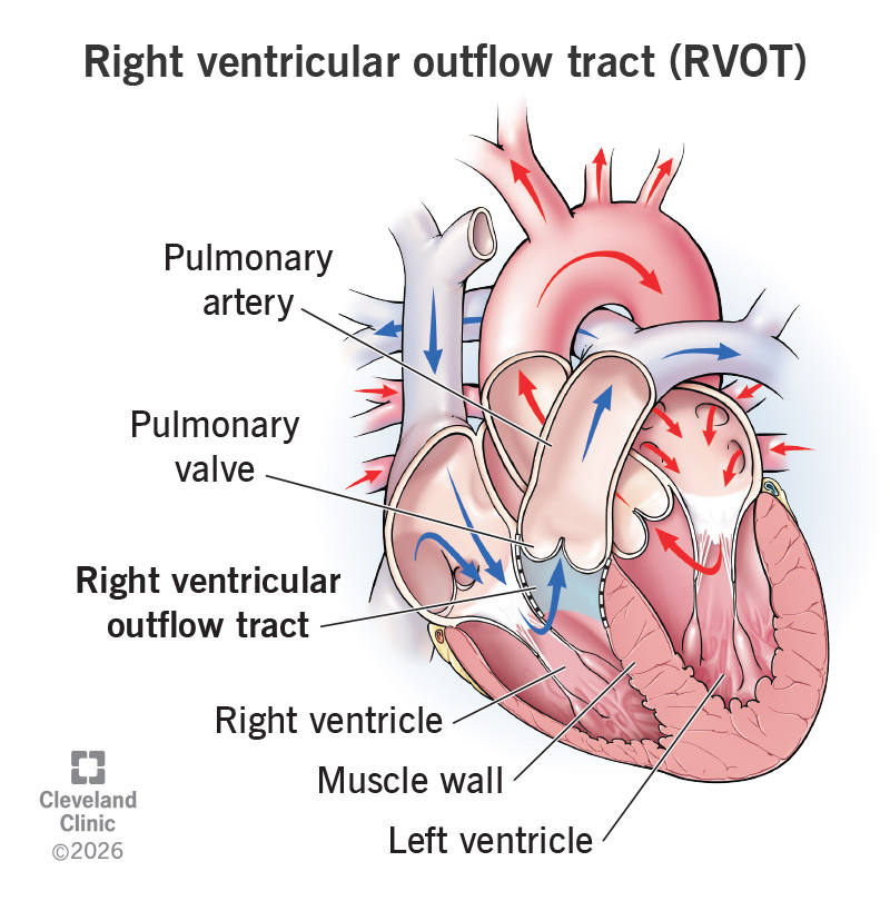Location of right ventricular outflow tract (RVOT) in the heart