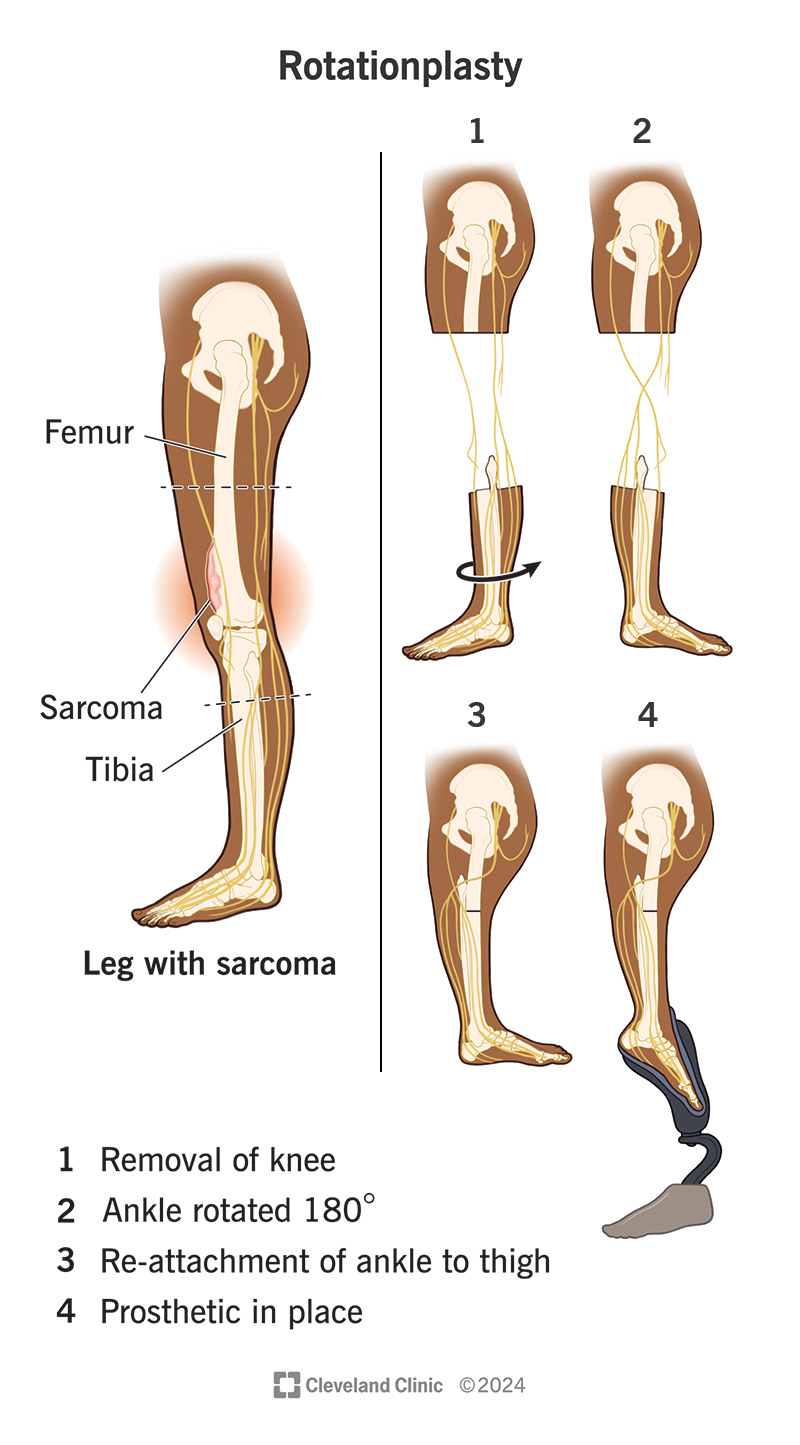 The rotationplasty procedure removes the middle of the leg and reattaches the lower leg backward (rotated 180 degrees)