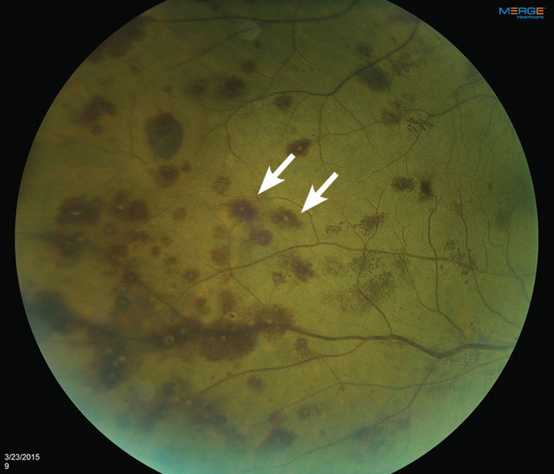 Close-up view of Roth spots, (arrows) characterized by a white center surrounded by hemorrhage (bleeding)