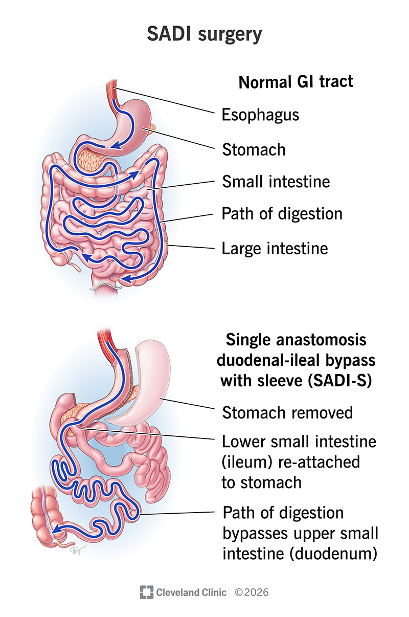 Anatomy of digestive organs and food pathway before and after SADI surgery