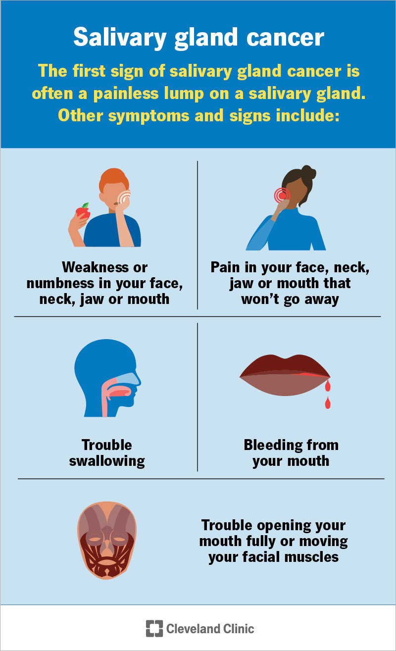 Common symptoms of salivary gland cancer, with the most common being a painless lump on a salivary gland