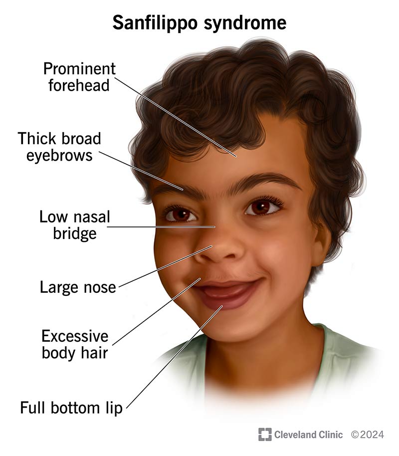 Sanfilippo Syndrome: What It Is, Symptoms & Treatment