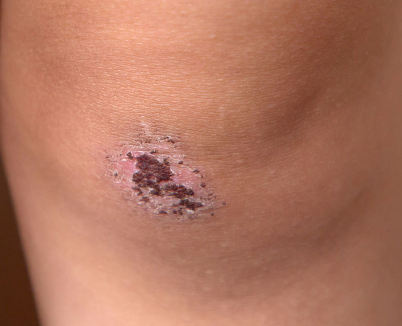 A person’s knee with a dark brown crust (scab) surrounded by pinkish skin